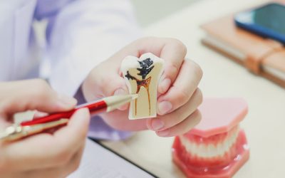 Ascessi dentali e devitalizzazioni