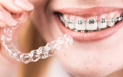 Ortodonzia fissa e allineatori trasparenti