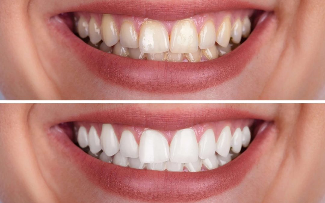 Sbiancamento dentale professionale